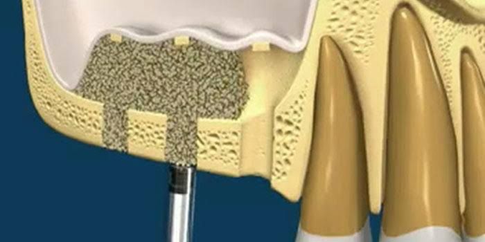 Use of Bone Powder in Dental Implants: Healthy and Permanent Solutions